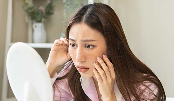 どれに当てはまる？【シミ・そばかす・肝斑】見分け方＆ケア方法